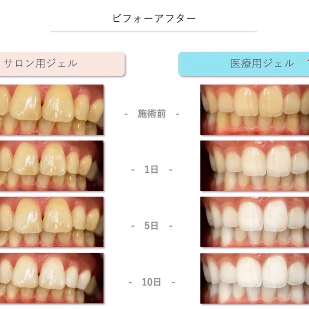 サロン用ジェルと医療用ジェルのビフォーアフター比較イメージ